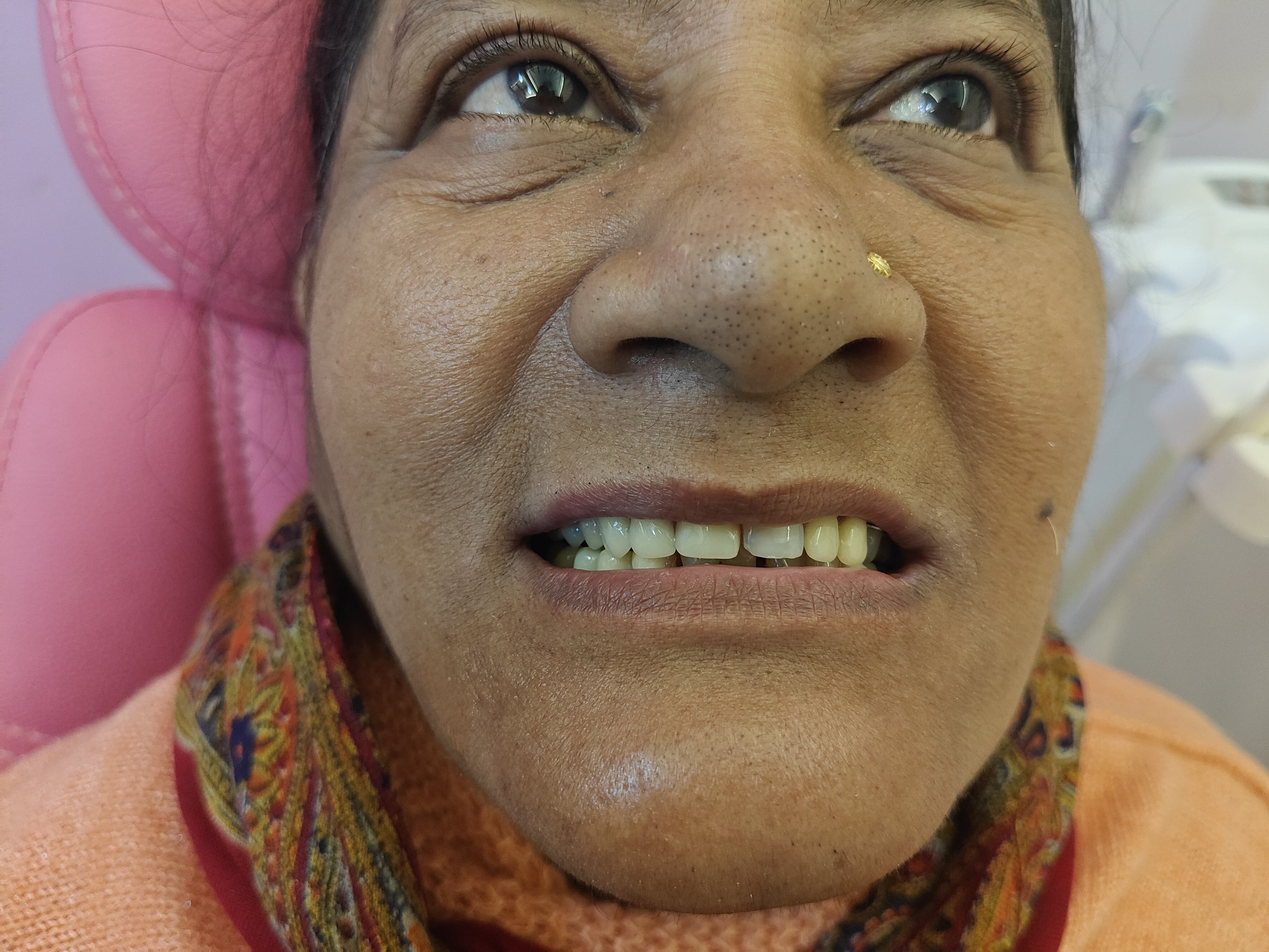 Smile Transformation Case 11